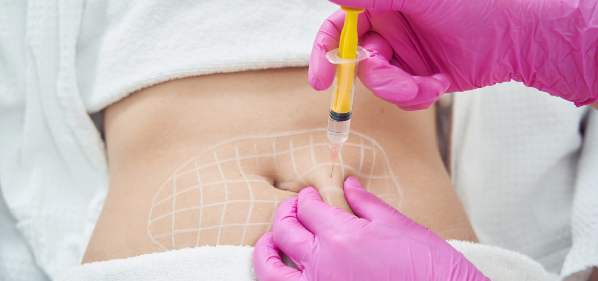 Anwendung der Fett-weg-Spritze (Injektionslipolyse) am Unterbauch zur gezielten Fettreduktion in der Praxis Juvanity Lampertheim