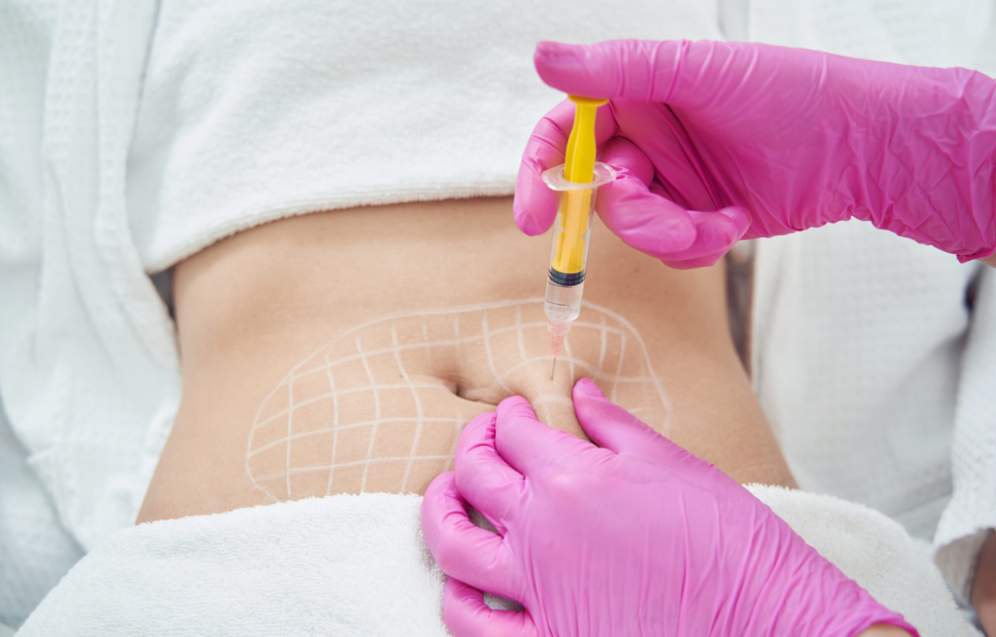 Anwendung der Fett-weg-Spritze (Injektionslipolyse) am Unterbauch zur gezielten Fettreduktion in der Praxis Juvanity Lampertheim