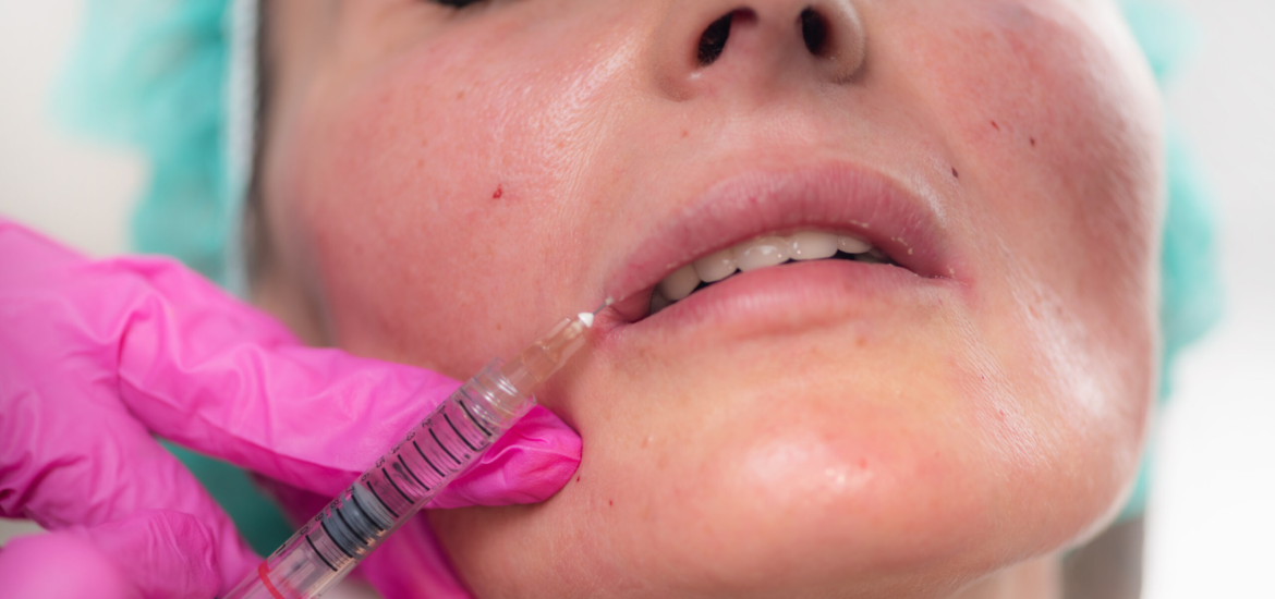 Lippenunterspritzung mit Hyaluronsäure zum Volumenaufbau und zur Konturierung in der Praxis Juvanity Lampertheim