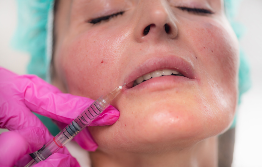 Lippenunterspritzung mit Hyaluronsäure zum Volumenaufbau und zur Konturierung in der Praxis Juvanity Lampertheim