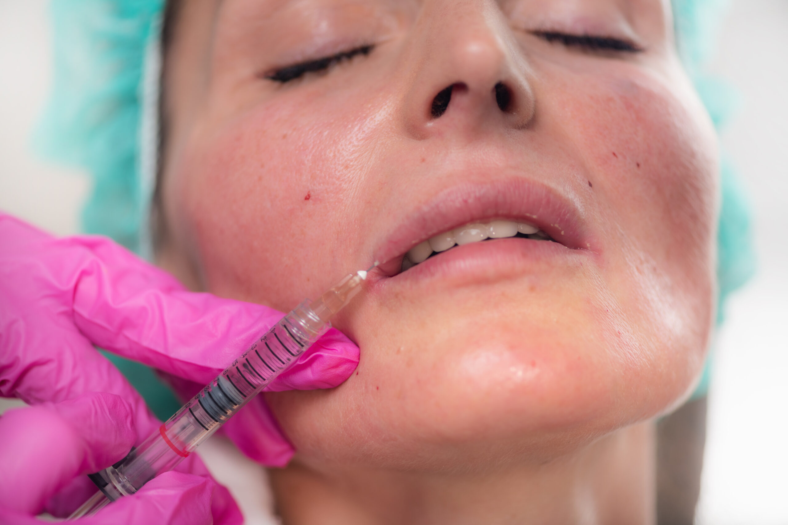 Lippenunterspritzung mit Hyaluronsäure zum Volumenaufbau und zur Konturierung in der Praxis Juvanity Lampertheim