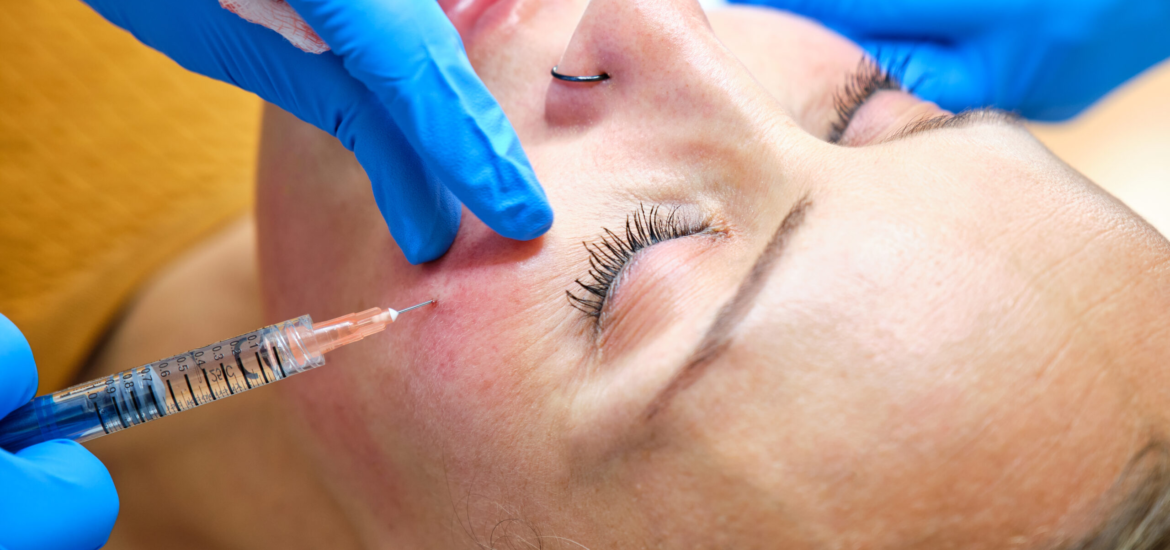 Hyaluronsäure-Injektion mit Kanüle zur Gesichtsverjüngung bei einer Frau ab 40 in der Praxis Juvanity Lampertheim