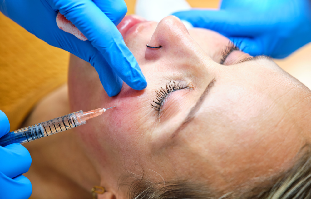 Hyaluronsäure-Injektion mit Kanüle zur Gesichtsverjüngung bei einer Frau ab 40 in der Praxis Juvanity Lampertheim