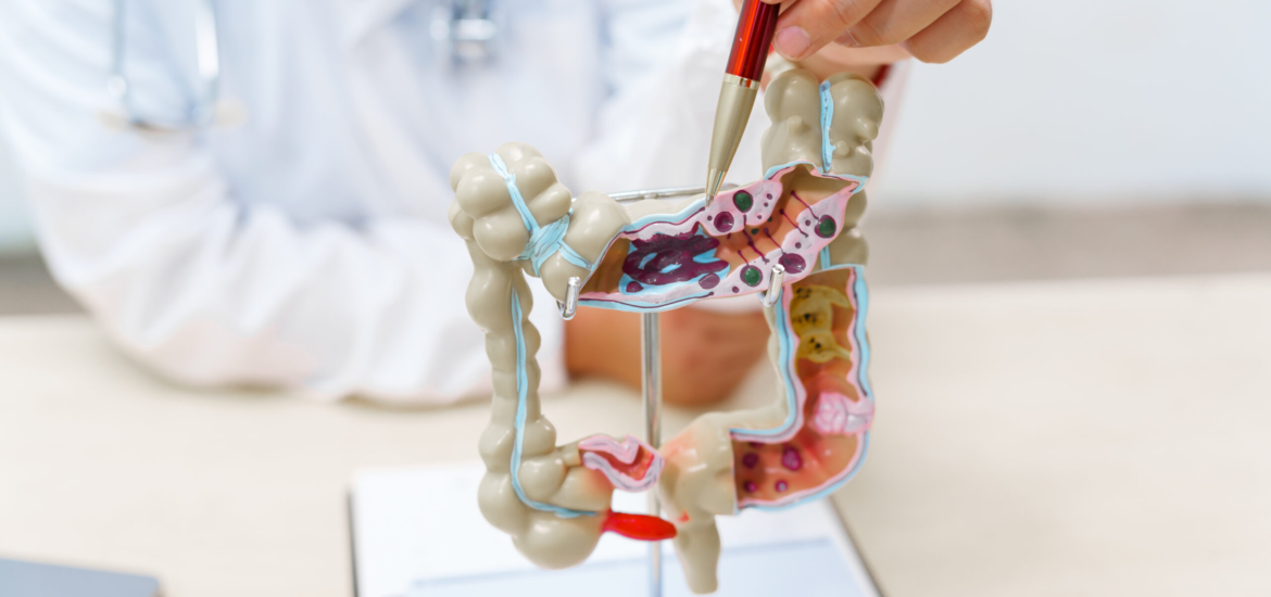 A doctor holds a human colon anatomy model, demonstrating the digestive system