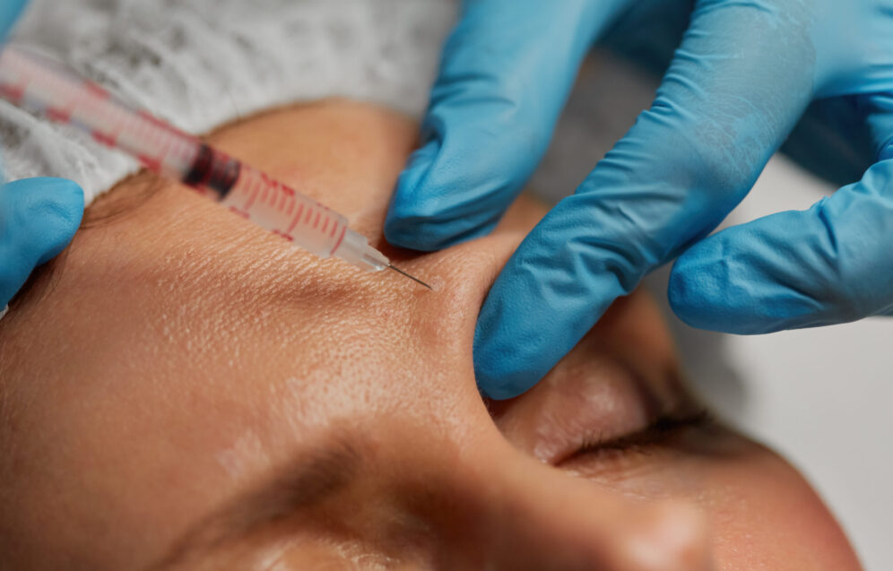 Hyaluron-Unterspritzung der Stirn als Anti-Aging-Behandlung in der Naturheilpraxis Juvanity