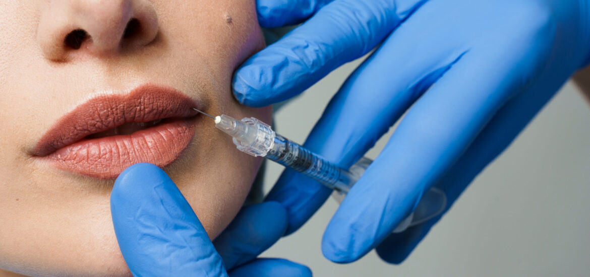 Clinical close-up of lip filler enhancement for aesthetic correction.