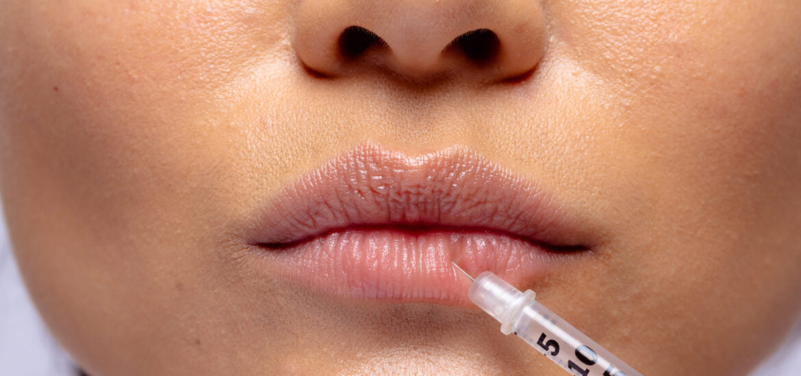 Close up of the lips of asian woman having collagen filler injection. Femininity, face, facial expressions, anti aging, skin and beauty treatments, unaltered.