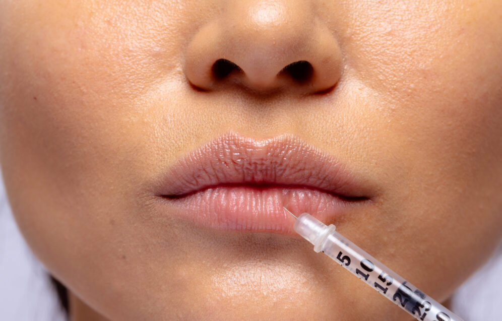 Close up of the lips of asian woman having collagen filler injection. Femininity, face, facial expressions, anti aging, skin and beauty treatments, unaltered.
