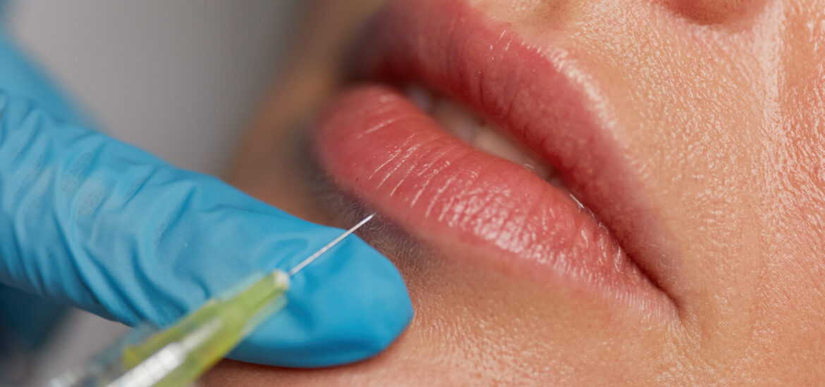Cosmetology augmentation injection to increase lips shape. Closeup syringe with needle over female mouth