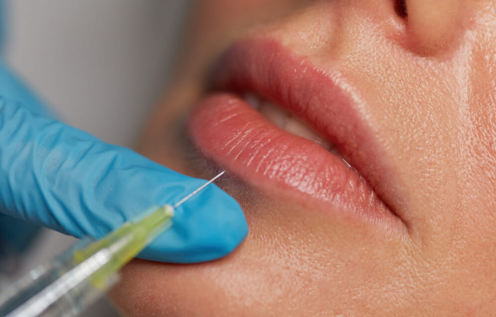 Cosmetology augmentation injection to increase lips shape. Closeup syringe with needle over female mouth