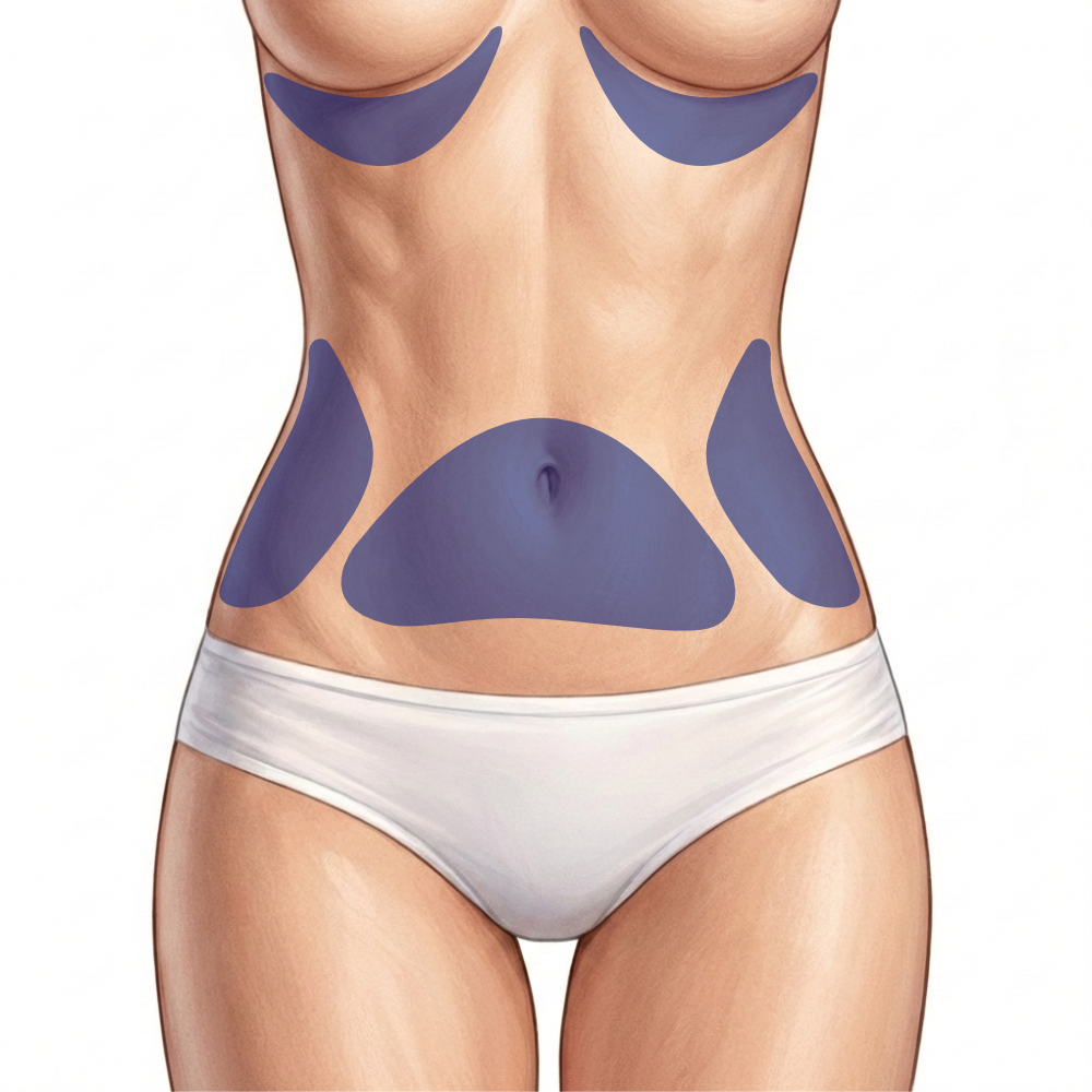 Fett weg Spritze Anwendung am Bauch und Hüften